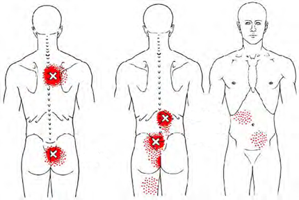 Multifid - Trigger Point Map