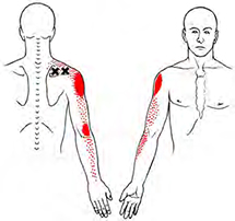 Supraspinatus - Trigger Point Map