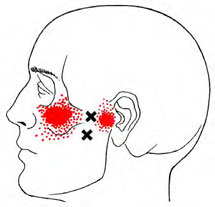 Lateral Pterygoids - Trigger Point Map