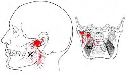 Medial Ptrygoid - Trigger Point Map