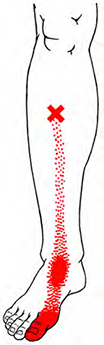 Tibialis Anterior - Trigger Point Map