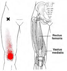 Rectus femoris / Vastus medialis - Trigger Point Map