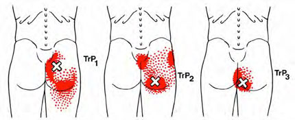 Sacro-coccygeal - Trigger Point Map