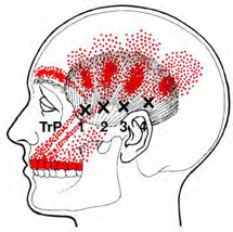 Temporalis - Trigger Point Map