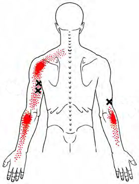 Triceps - Trigger Point Map